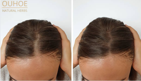 OUHOE ®: RESULTADOS VISIBLES EN SEMANAS